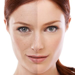 TREATMENTS_CHEMICAL-PEELS_fraxel-laser-treatment Fraxel Melbourne