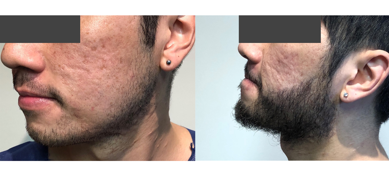 Double Chin Reduction Treatment Melbourne | Dr Tass
