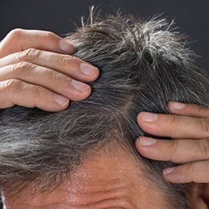 drtass_hair_transpant_05 Dr Tass - Hair Transplant