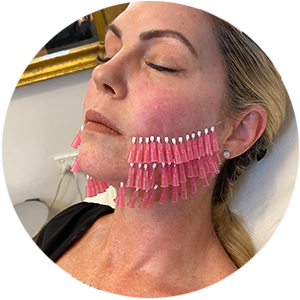 Dr Tass - Thread Lifts - Face