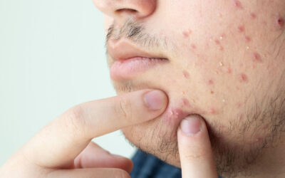 How Can I Reduce Acne Scarring?