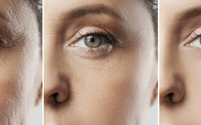 Thermage Laser Treatment in Melbourne: All There is to Know