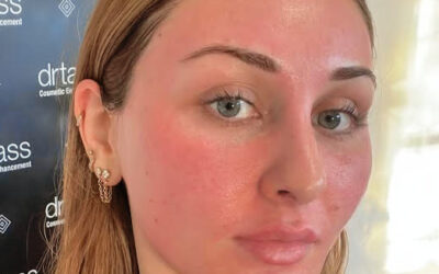 Why Fraxel Laser Is the Must-Have Treatment for Total Skin Rejuvenation