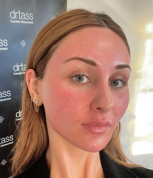 drtass_blogPost_image_may06-2025 microdermabrasion melbourne