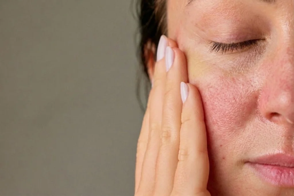 signs of over exfoliation including redness and skin barrier disruption