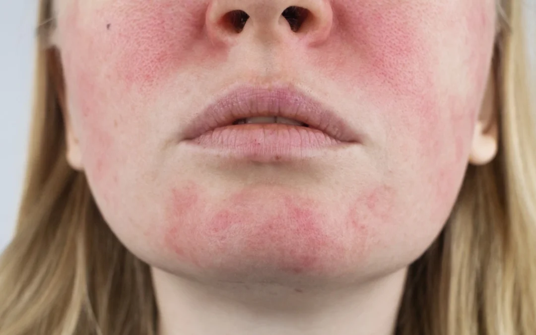 Over Exfoliated Skin: Signs, Symptoms & How to Fix It