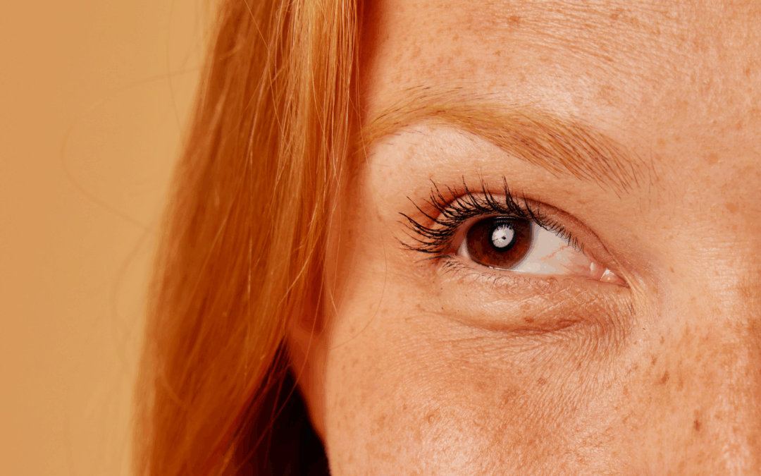 Freckles Removal Treatments: What Are Your Options?